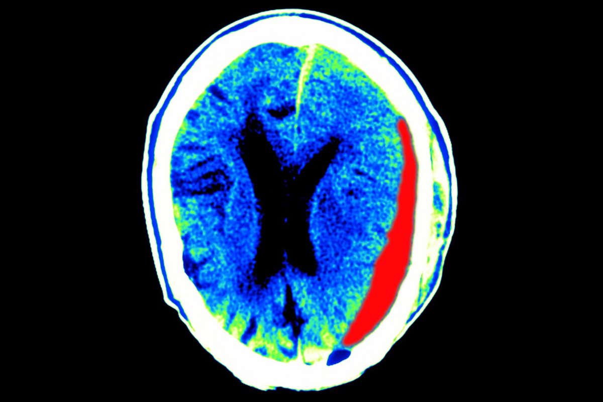 A subdural hematoma, where blood collects between the skull and the surface of the brain, which can occur after a head injury